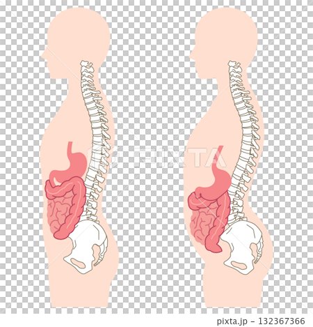 内臓下垂　内臓の位置が下がっている状態 132367366