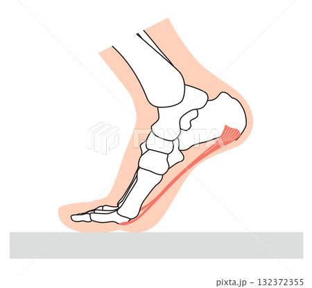 足底筋膜炎　足底筋膜　足底腱膜　足の筋肉 132372355