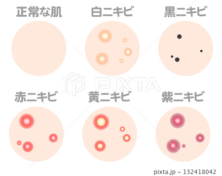 様々なニキビの症例と種類のイラスト素材セット2 様々なニキビの症例と種類のイラスト素材セット2 132418042