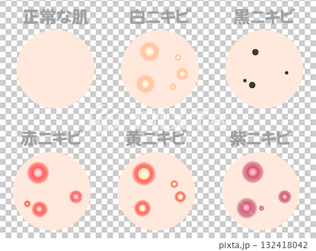 様々なニキビの症例と種類のイラスト素材セット2 様々なニキビの症例と種類のイラスト素材セット2 132418042