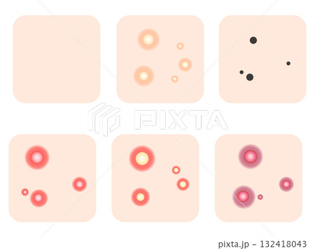 様々なニキビの症例と種類のイラスト素材セット3 132418043