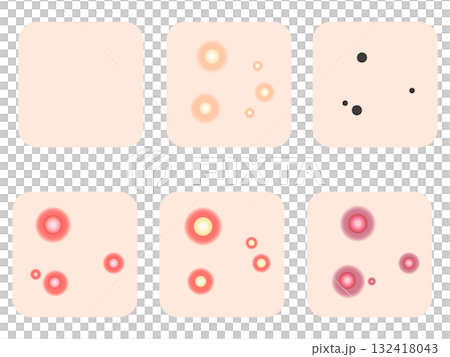 様々なニキビの症例と種類のイラスト素材セット3 132418043