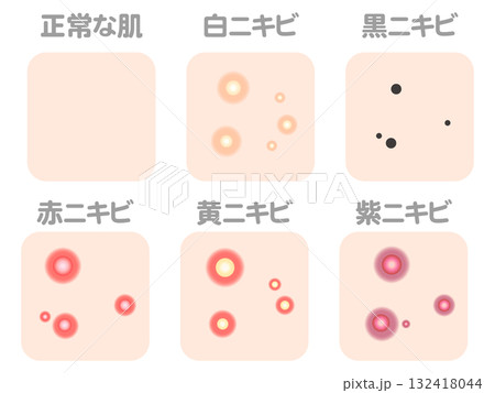 様々なニキビの症例と種類のイラスト素材セット4 132418044