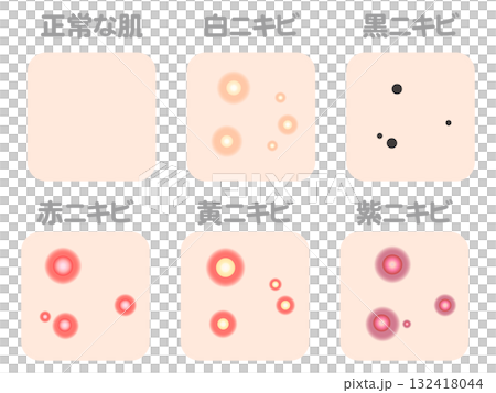 各種痤瘡病例和類型插圖素材套裝4 132418044