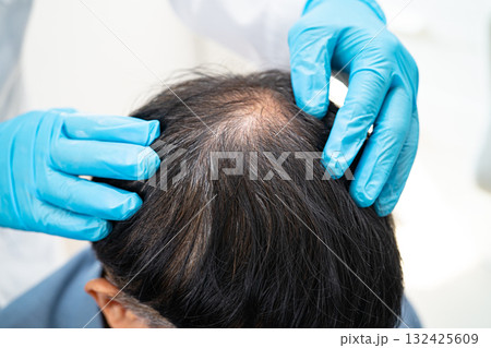Doctor checkup and treatment Asian man baldness hair problem patient. Doctor checkup and treatment Asian man baldness hair problem patient. 132425609