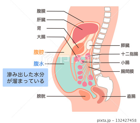 腹水が溜まった腹部 腹水が溜まった腹部 132427458