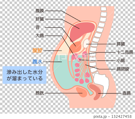 腹水が溜まった腹部 腹水が溜まった腹部 132427458