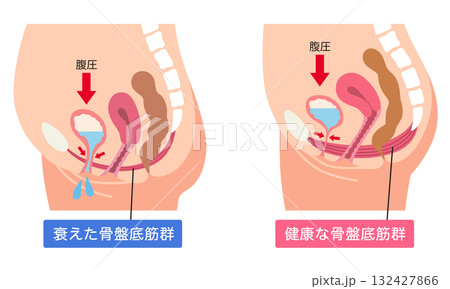 衰えた骨盤底筋群と健康な骨盤底筋群 132427866
