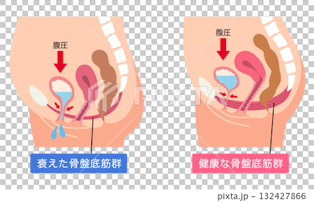 衰えた骨盤底筋群と健康な骨盤底筋群 132427866