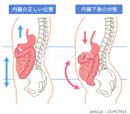 内臓下垂 内臓の位置が下がっている状態 内臓下垂 内臓の位置が下がっている状態 132427921