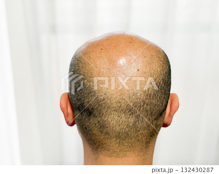 薄毛が悩みの中年男性 132430287
