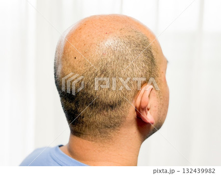 薄毛の中年男性 薄毛の中年男性 132439982