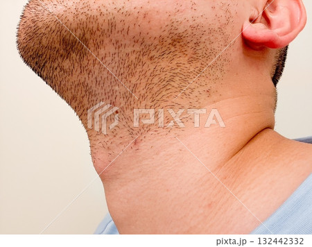 髭脱毛　Beforeイメージ　メンズエステ 132442332