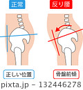 反り腰の骨盤前傾と正常な骨盤の位置 132446278