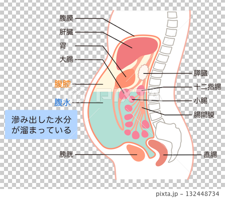 腹水が溜まった腹部 132448734