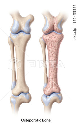 Healthy vs Osteoporotic Bone Microstructure Healthy vs Osteoporotic Bone Microstructure 132455533