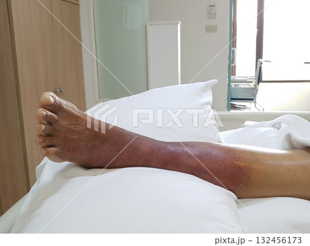 Purpura caused by cancer on leg is side effect of chemotherapy or caused by cancer cells interfering with platelet production in the bone marrow. 132456173