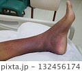 Purpura caused by cancer on leg is side effect of chemotherapy or caused by cancer cells interfering with platelet production in the bone marrow. 132456174