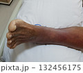 Purpura caused by cancer on leg is side effect of chemotherapy or caused by cancer cells interfering with platelet production in the bone marrow. 132456175