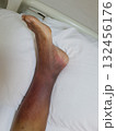 Purpura caused by cancer on leg is side effect of chemotherapy or caused by cancer cells interfering with platelet production in the bone marrow. 132456176