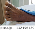 Purpura caused by cancer on leg is side effect of chemotherapy or caused by cancer cells interfering with platelet production in the bone marrow. 132456180