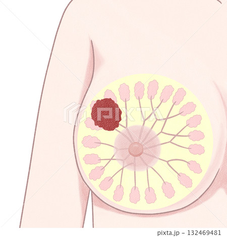 乳がん　ステージⅢ（3期）　わかりやすい図解イラスト 132469481