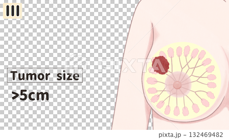 乳癌III期（第三期）簡單易懂的英文插圖 132469482