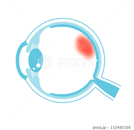 眼底出血 ベクターイラスト 132485108