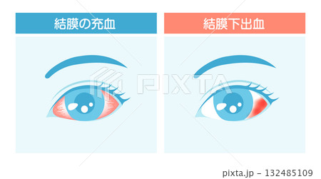 結膜下出血と結膜の充血 比較ベクターイラスト 132485109