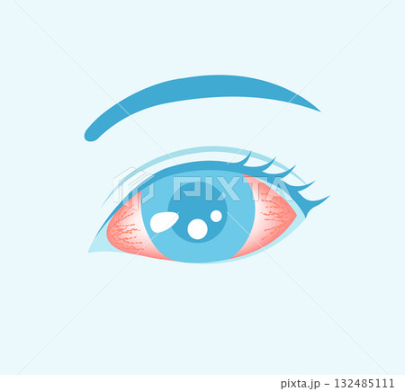 結膜炎・結膜の充血 ベクターイラスト 132485111
