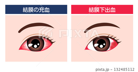 結膜下出血と結膜の充血 比較ベクターイラスト 結膜下出血と結膜の充血 比較ベクターイラスト 132485112