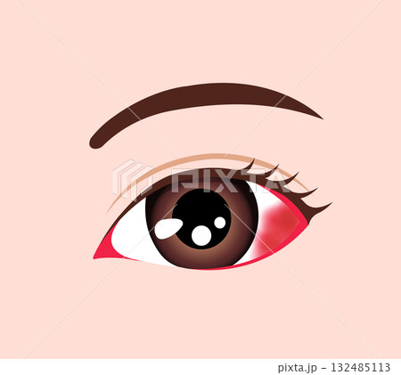 結膜下出血 ベクターイラスト 結膜下出血 ベクターイラスト 132485113