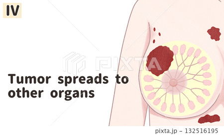乳がん ステージⅣ(4期) わかりやすい英語図解イラスト 乳がん ステージⅣ(4期) わかりやすい英語図解イラスト 132516195