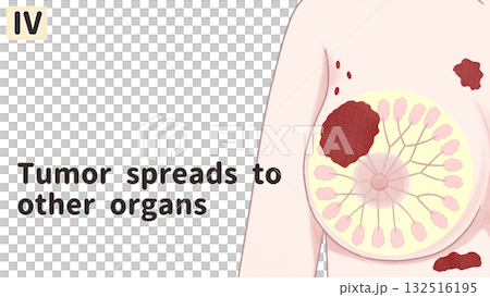 乳がん ステージⅣ(4期) わかりやすい英語図解イラスト 乳がん ステージⅣ(4期) わかりやすい英語図解イラスト 132516195