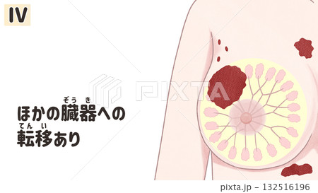 乳がん ステージⅣ(4期) わかりやすい日本語図解イラスト 乳がん ステージⅣ(4期) わかりやすい日本語図解イラスト 132516196
