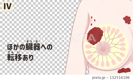 乳がん ステージⅣ(4期) わかりやすい日本語図解イラスト 乳がん ステージⅣ(4期) わかりやすい日本語図解イラスト 132516196