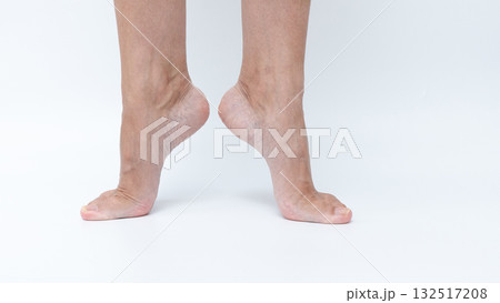 Varicose veins and spider veins on legs displayed in a clinical setting, highlighting treatment options and showcasing healthy leg appearance Varicose veins and spider veins on legs displayed in a clinical setting, highlighting treatment options and showcasing healthy leg appearance 132517208