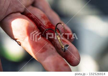 Fishing Hook Embedded in Hand A Cautionary Tale of Angling Mishaps and First Aid Needs Fishing Hook Embedded in Hand A Cautionary Tale of Angling Mishaps and First Aid Needs 132526914