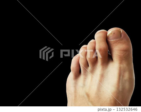 Human foot showing toenail separation and damage on big toe, transparent background. For medical, dermatology, podiatry, healthcare illustrations focused on nail disorders, treatment, and prevention 132532646
