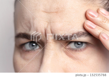Portrait of Caucasian middle-aged woman pointing to the wrinkles on the upper eyelid forehead and bridge of nose. Signs of aging on the face close up Portrait of Caucasian middle-aged woman pointing to the wrinkles on the upper eyelid forehead and bridge of nose. Signs of aging on the face close up 132535788