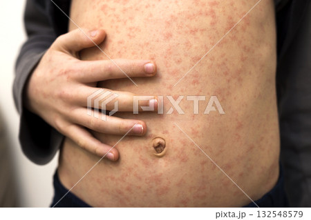 Sick child body, stomach with red rush spots from measles or chicken pox. Contagious child diseases and treatment. Sick child body, stomach with red rush spots from measles or chicken pox. Contagious child diseases and treatment. 132548579