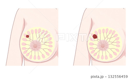 乳がん　ステージⅠ ステージⅡ セット　わかりやすい図解イラスト 132556459