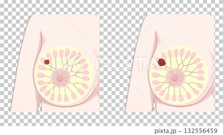 乳がん　ステージⅠ ステージⅡ セット　わかりやすい図解イラスト 132556459
