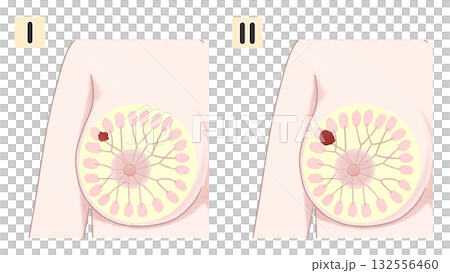 乳癌I期和II期圖解－簡單易懂的插圖 132556460