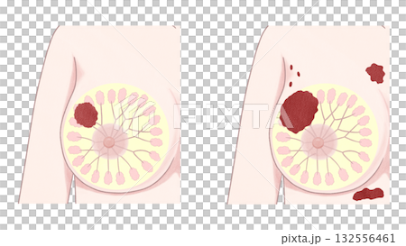 乳がん　ステージⅢ ステージⅣ セット　わかりやすい図解イラスト 132556461