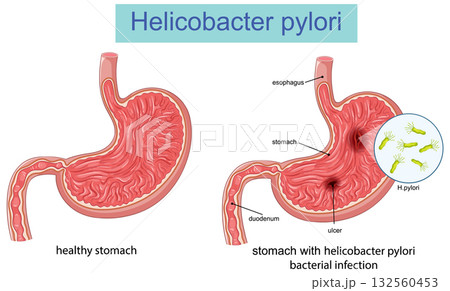 Comparison of Healthy Stomach and Helicobacter Pylori Infection 132560453