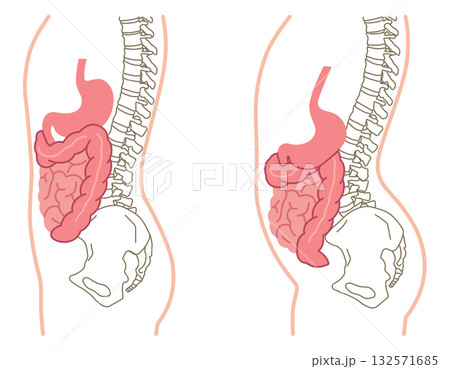 内臓下垂　内臓の位置が下がっている状態 132571685