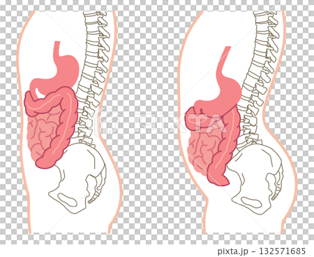 内臓下垂　内臓の位置が下がっている状態 132571685