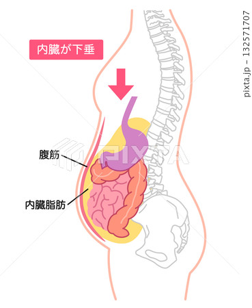 内臓下垂　内臓の位置が下がっている状態 132571707