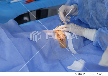 Gloved surgeon injects local anesthesia into a marked eyelid before blepharoplasty under sterile drapes in a modern clinic Gloved surgeon injects local anesthesia into a marked eyelid before blepharoplasty under sterile drapes in a modern clinic 132573282